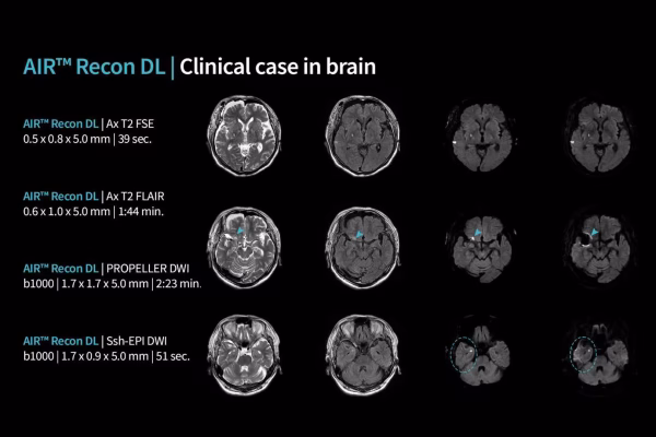 Cas clinique en imagerie cérébrale