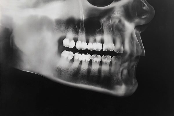 Image en radiographie monochrome d’un crâne humain, révélant les structures osseuses avec un contraste élevé.