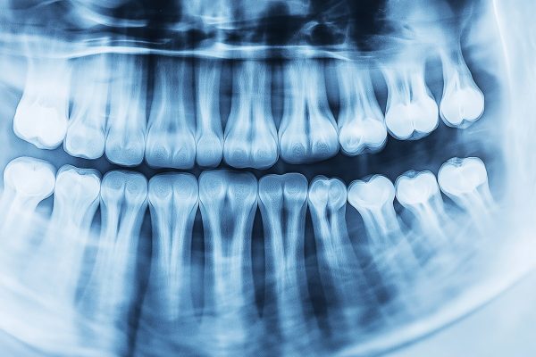 Panoramic Dental X-ray